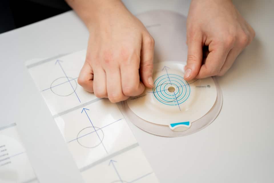 Tilpasning av hudplate og stomimal